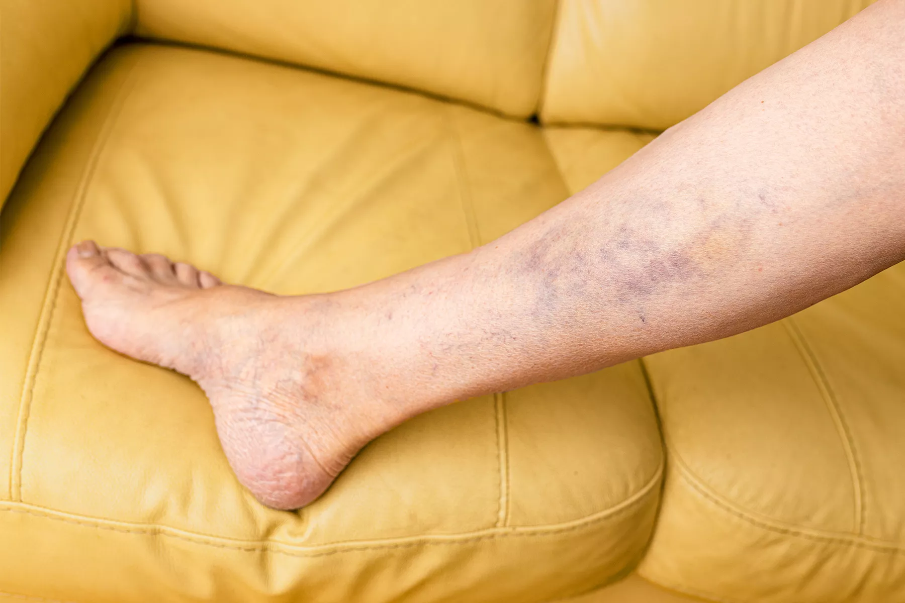 Learn about hemosiderin staining, its causes like chronic venous insufficiency, symptoms, and effective treatments such as laser therapy, compression therapy, and lifestyle changes to improve vein health and skin discoloration.